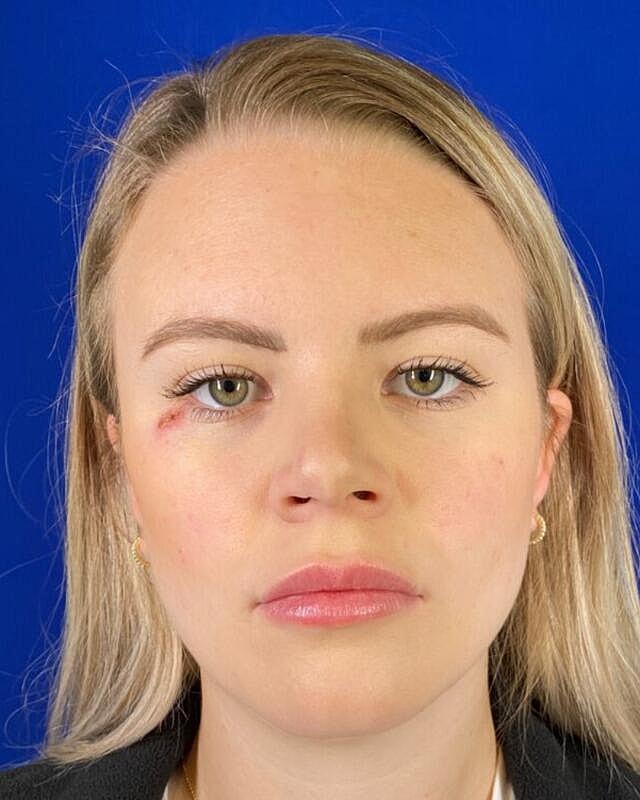Injectables Before & After