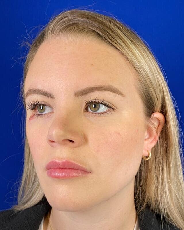 Injectables Before & After