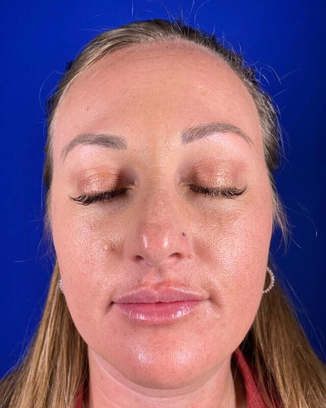 Injectables Before & After