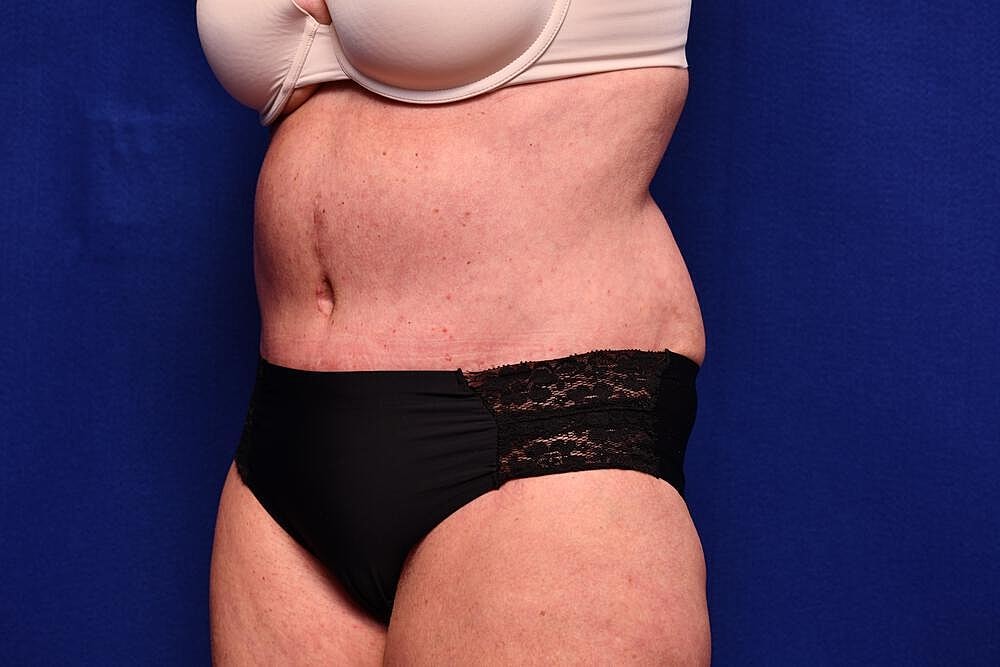 Tummy Tuck Before & After