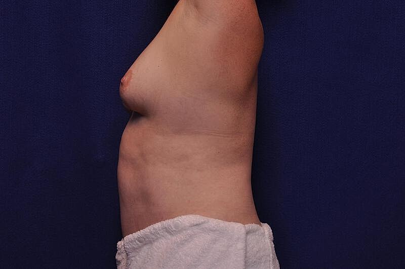 Tummy Tuck Before & After