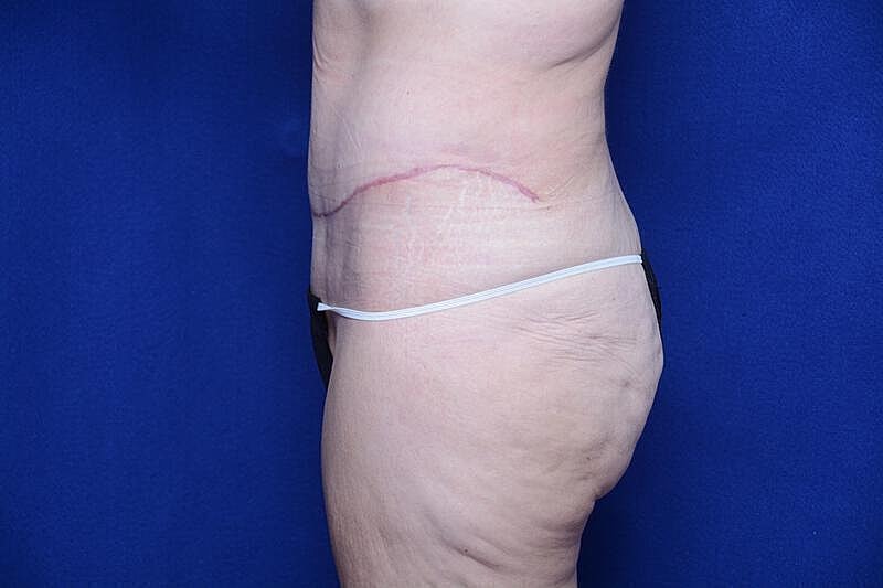 Tummy Tuck Before & After