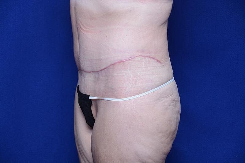 Tummy Tuck Before & After