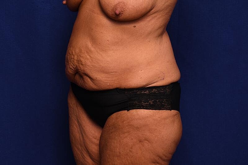 Tummy Tuck Before & After