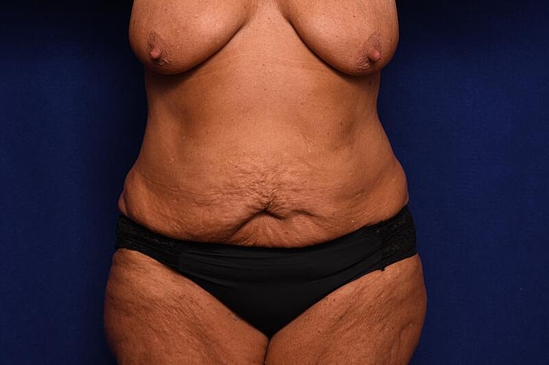 Tummy Tuck Before & After
