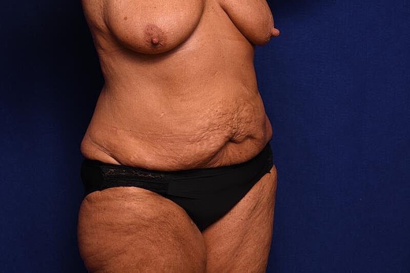 Tummy Tuck Before & After
