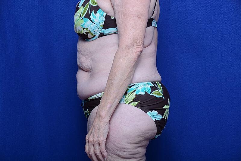 Tummy Tuck Before & After