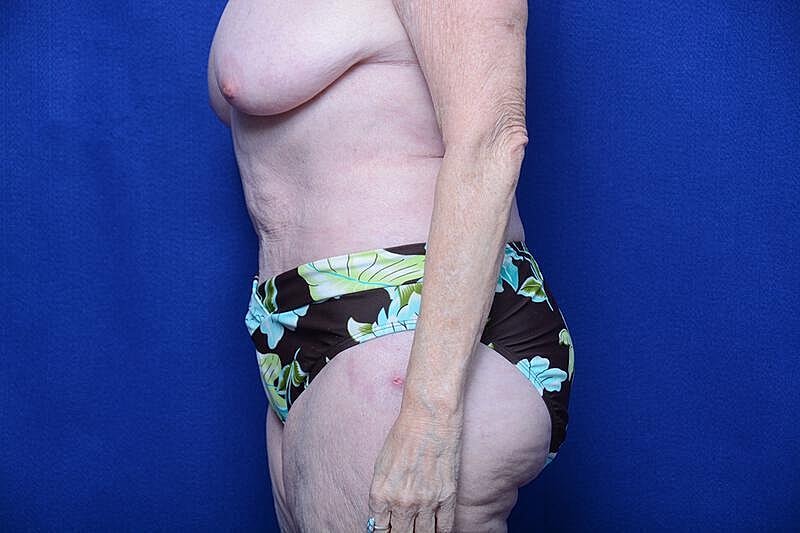 Tummy Tuck Before & After