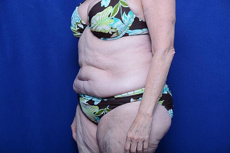 Tummy Tuck Before & After