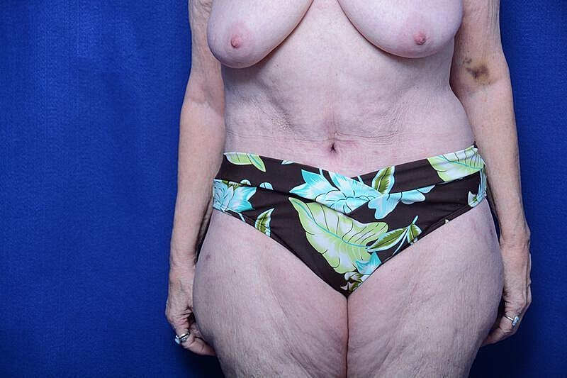 Tummy Tuck Before & After