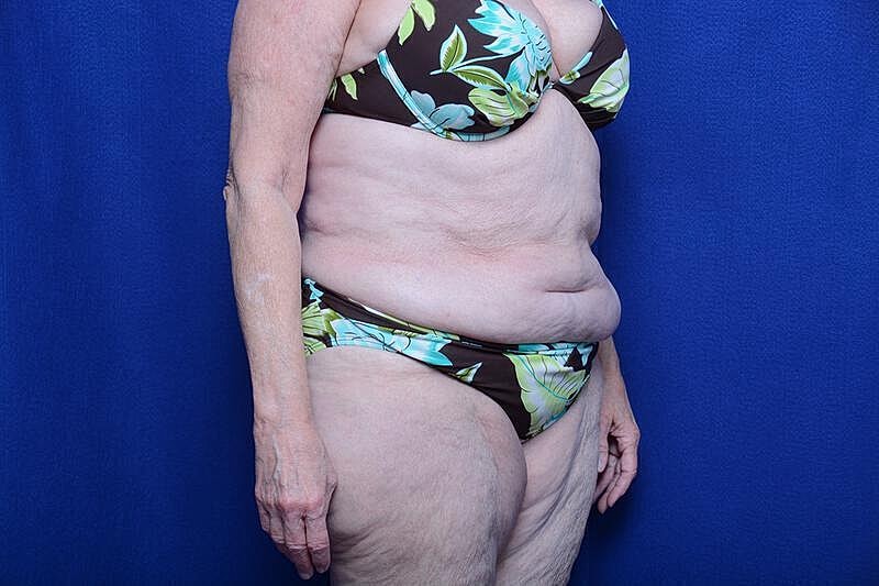 Tummy Tuck Before & After