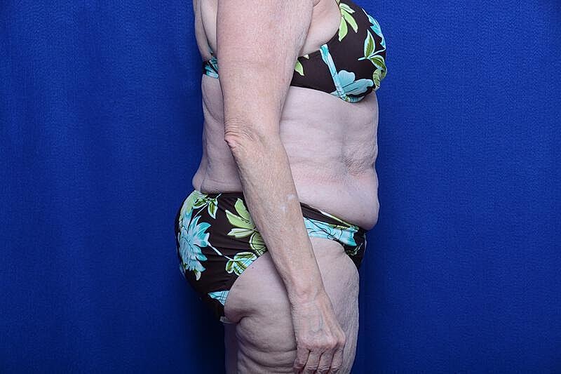 Tummy Tuck Before & After