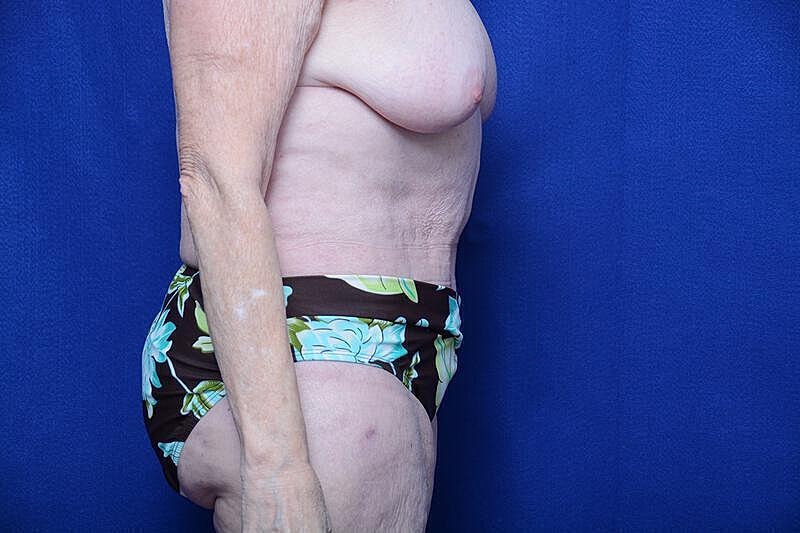 Tummy Tuck Before & After