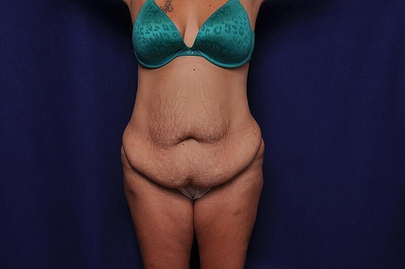 Tummy Tuck Before & After