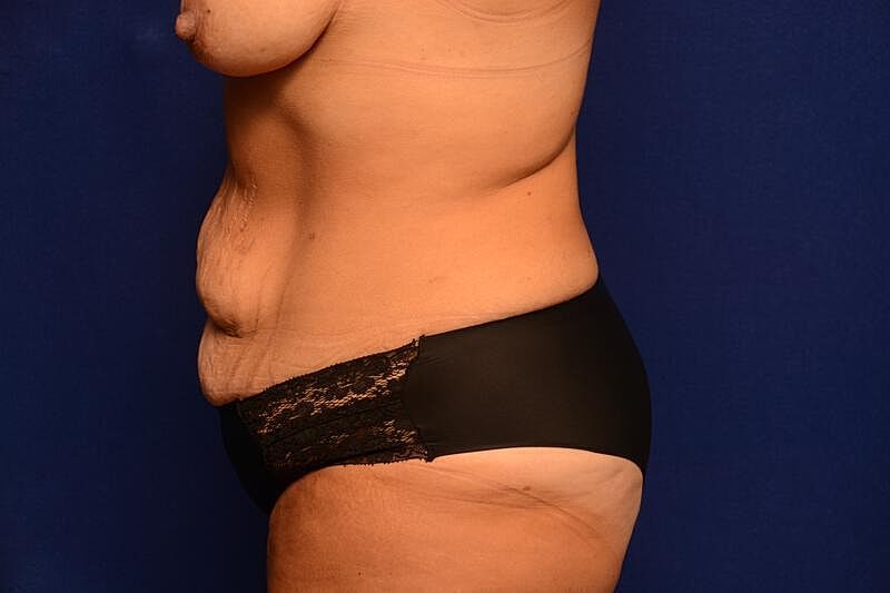 Tummy Tuck Before & After