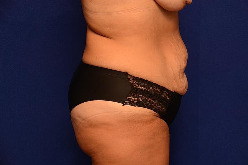 Tummy Tuck Before & After