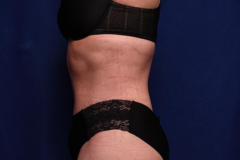 Tummy Tuck Before & After