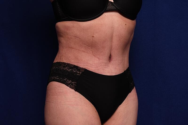 Tummy Tuck Before & After