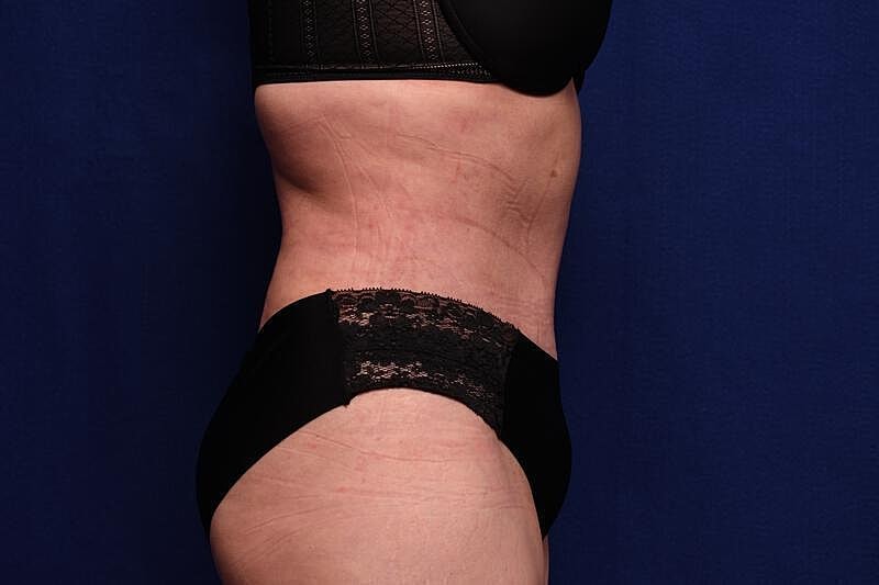 Tummy Tuck Before & After