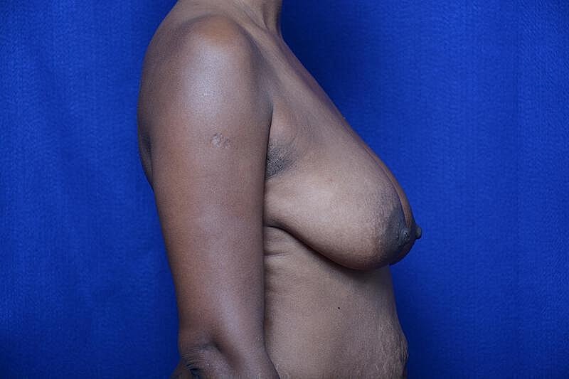 Breast Lift Before & After
