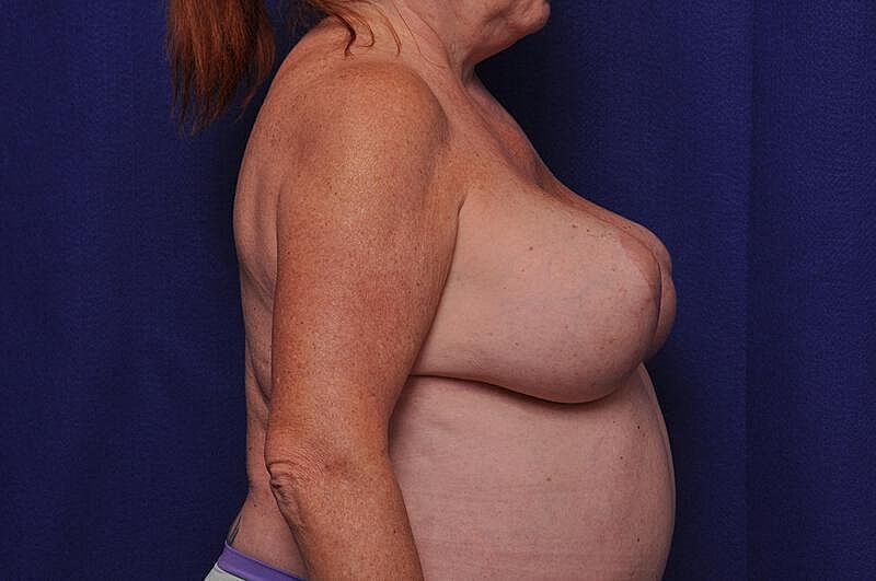Breast Lift Before & After
