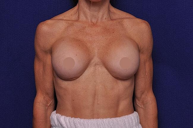 Athletic Breast Augmentation Revision Before & After