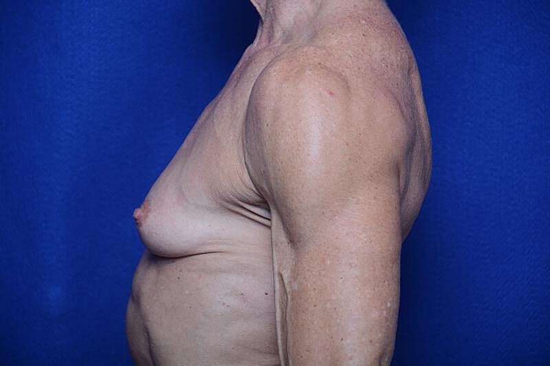 Athletic Breast Augmentation Revision Before & After