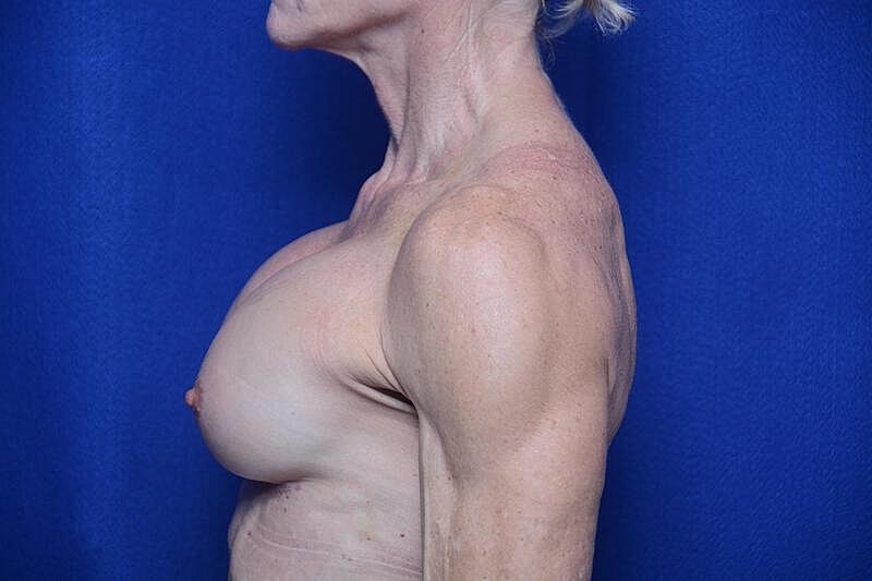 Athletic Breast Augmentation Revision Before & After
