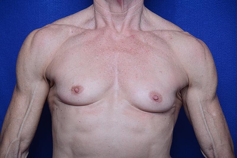 Athletic Breast Augmentation Revision Before & After