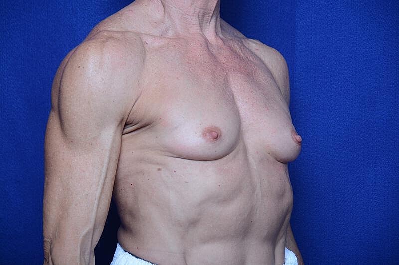 Athletic Breast Augmentation Revision Before & After