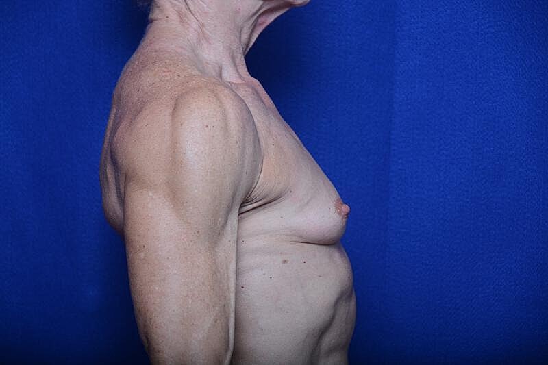Athletic Breast Augmentation Revision Before & After