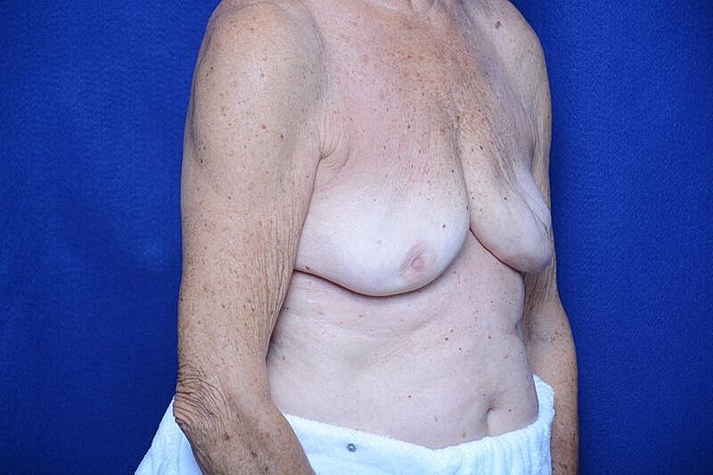 Breast Augmentation Before & After