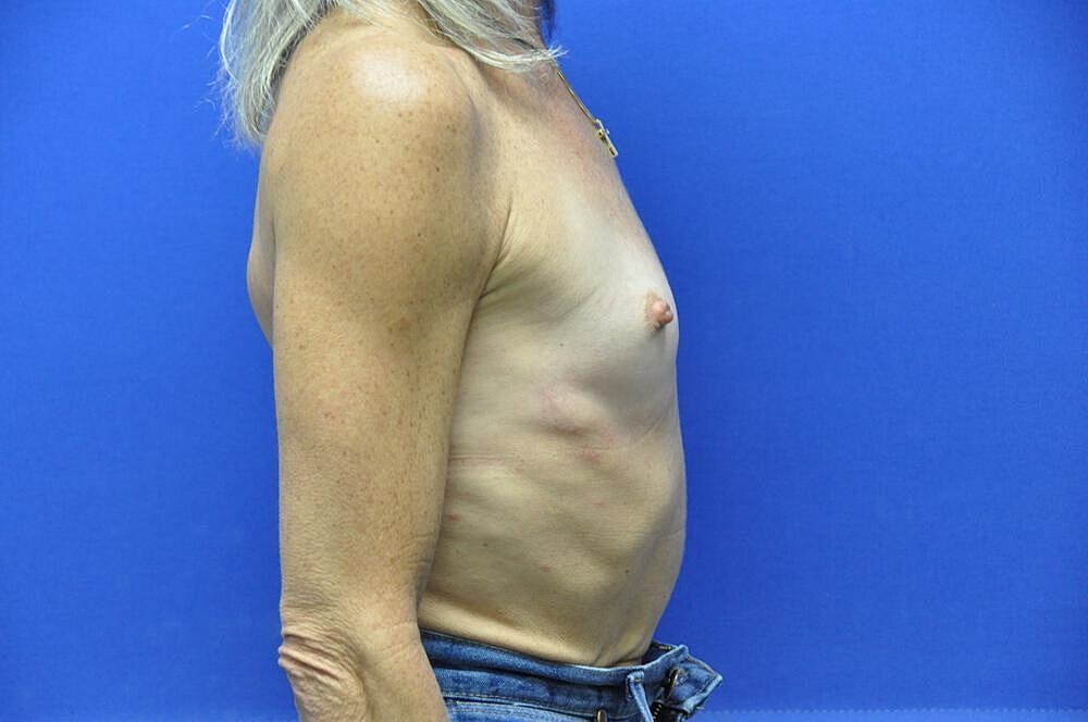 Breast Augmentation Before & After