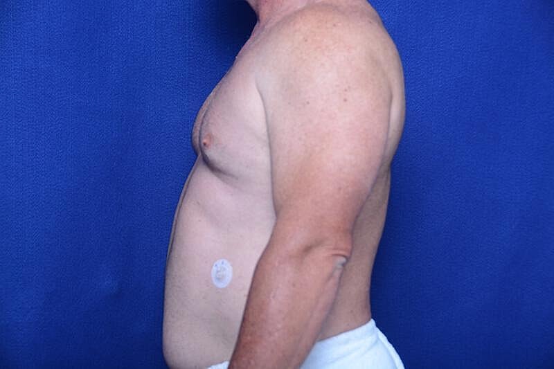 Gynecomastia Surgery Before & After