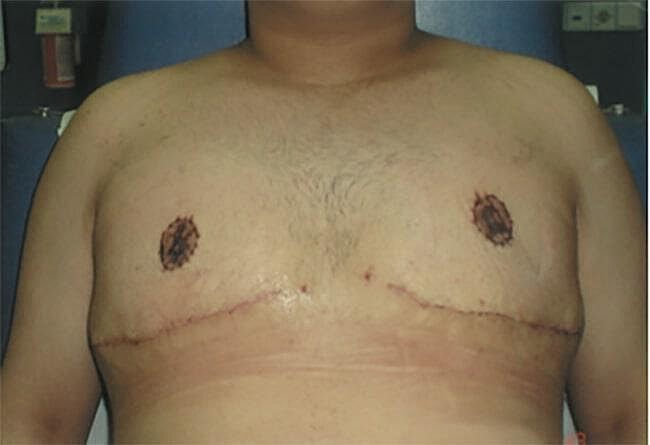 Gynecomastia Surgery Before & After