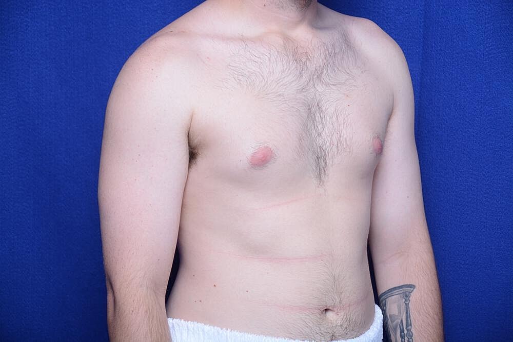 Gynecomastia Surgery Before & After