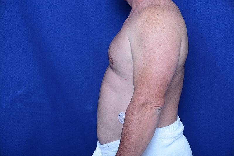 Gynecomastia Surgery Before & After