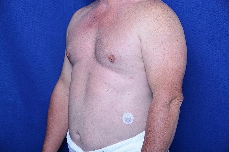 Gynecomastia Surgery Before & After