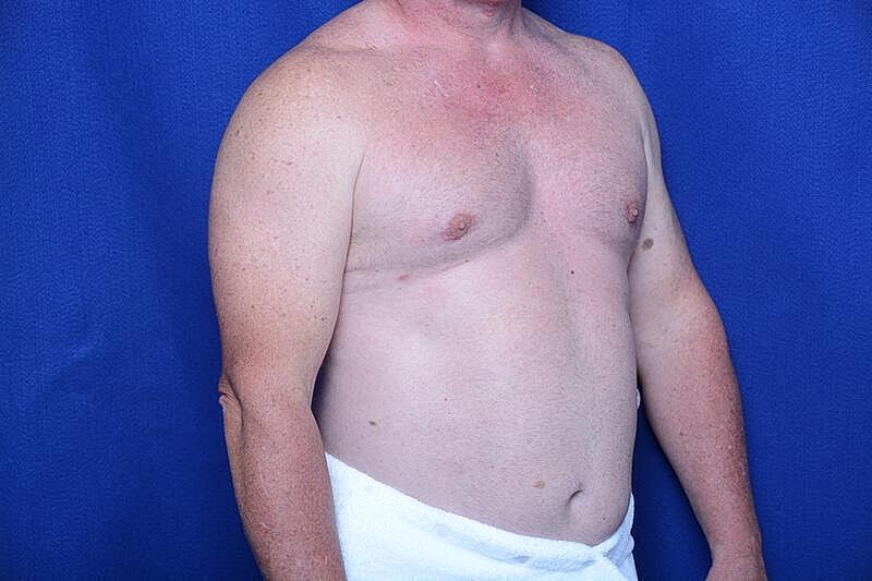 Gynecomastia Surgery Before & After