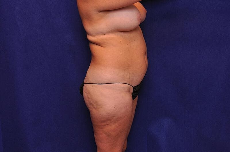 Liposuction Before & After