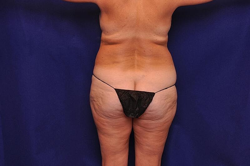 Liposuction Before & After