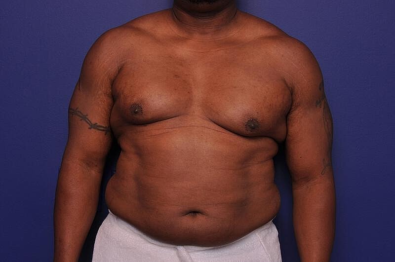 Liposuction Before & After