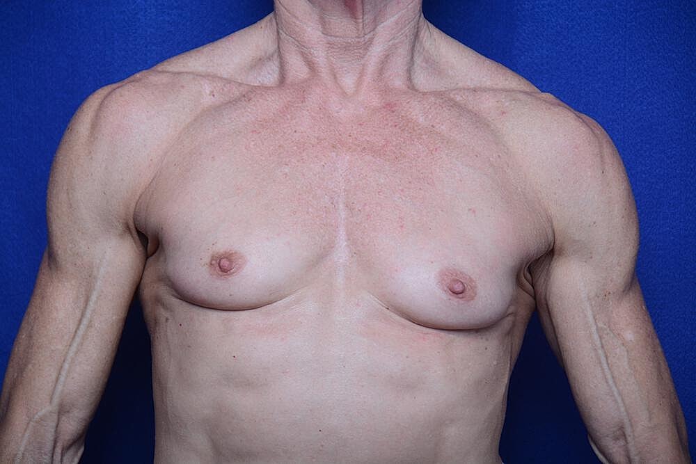 Athletic Breast Augmentation Before & After