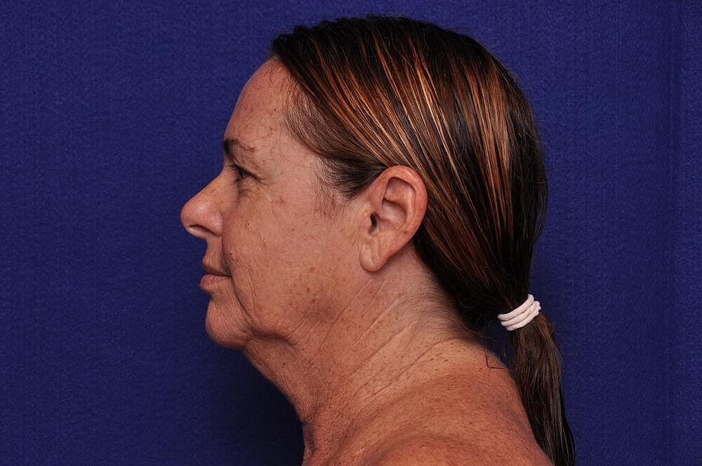 Upper Blepharoplasty Before & After