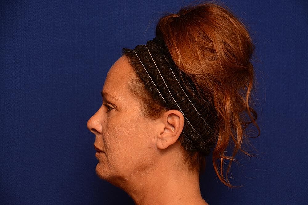 Upper Blepharoplasty Before & After