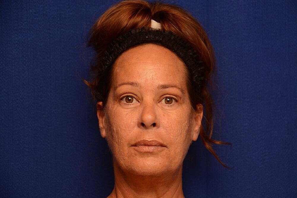 Upper Blepharoplasty Before & After
