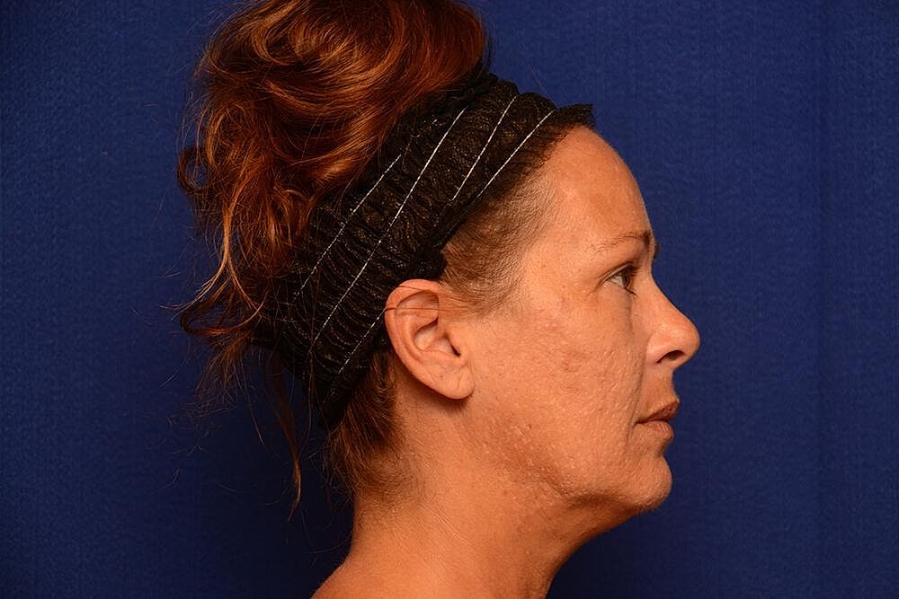 Upper Blepharoplasty Before & After