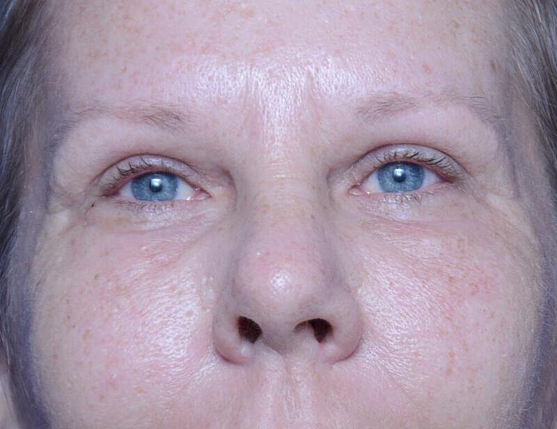Upper Blepharoplasty Before & After