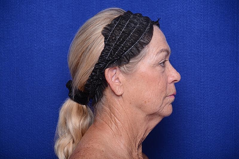 Upper Blepharoplasty Before & After
