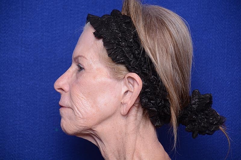 Upper Blepharoplasty Before & After